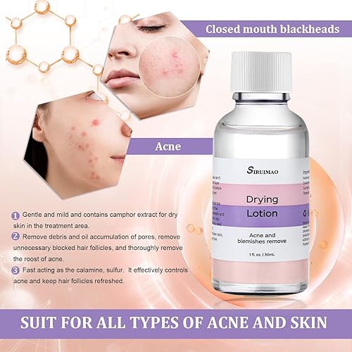 Miniatura 4 de Loción de secado para el acné persistente (1 onza), tratamiento de manchas de acné y acné durante la noche para cara y cuerpo, loción de espinillas,