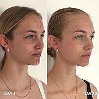 Vista 5 de Clinisoothe + Purificador de la piel: limpiador diario y tratamiento del acné para la cara y el cuerpo, con tecnología hipoclorosa para prevenir