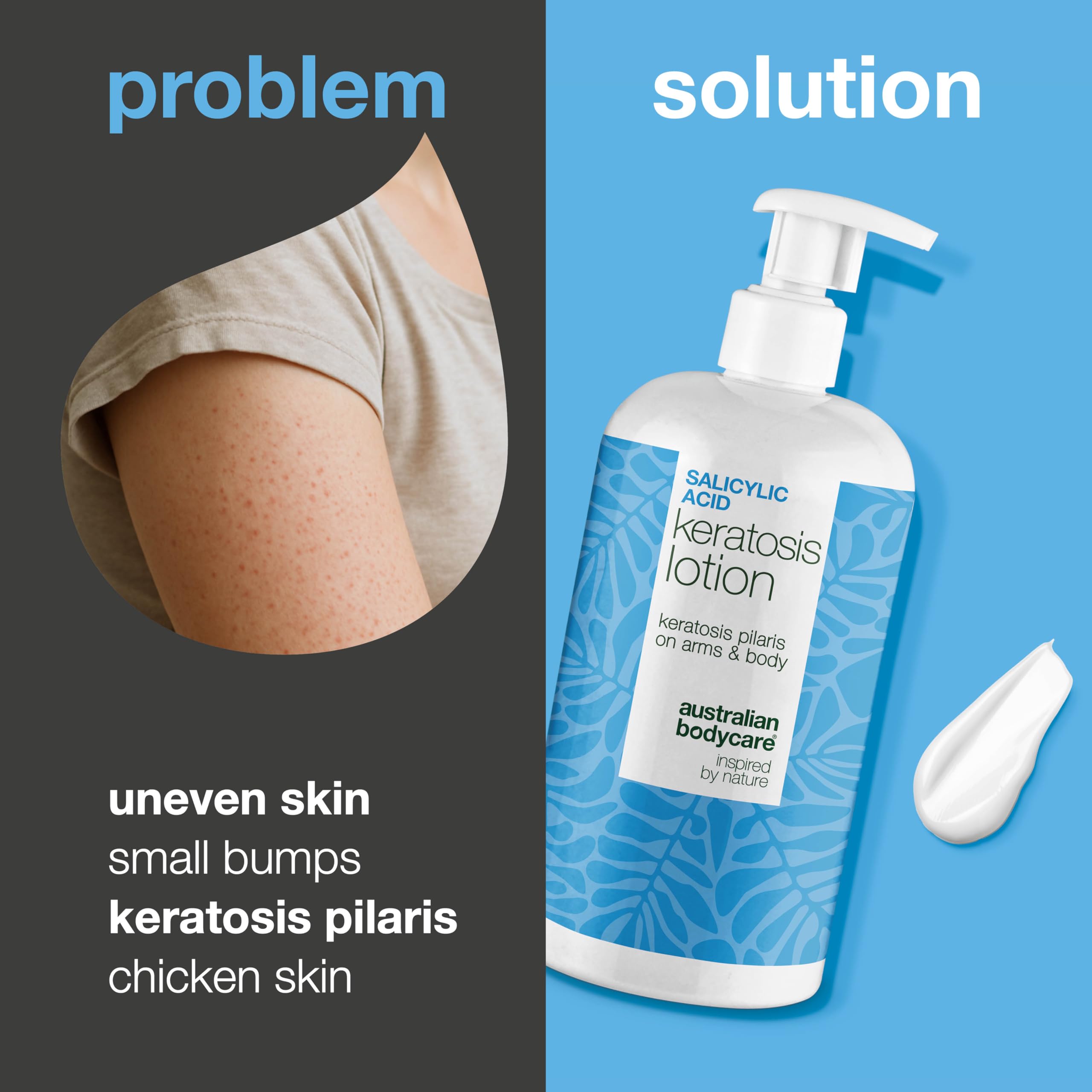 Keratosis Pilaris Body Lotion - Smooths Bumpy Skin, Chicken Skin & Strawberry Legs - Treatment with Salicylic Acid, Niacinamide & Zinc - Image 2