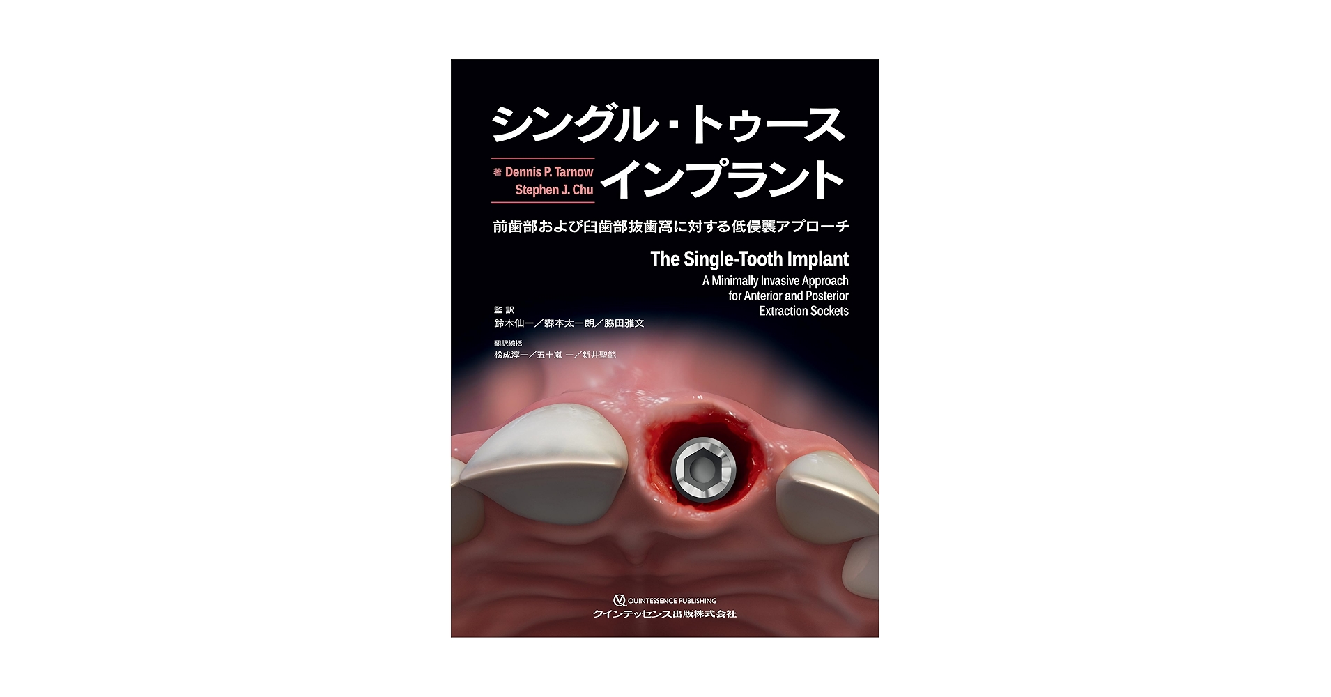 シングル・トゥースインプラント: 前歯部および臼歯部抜歯窩