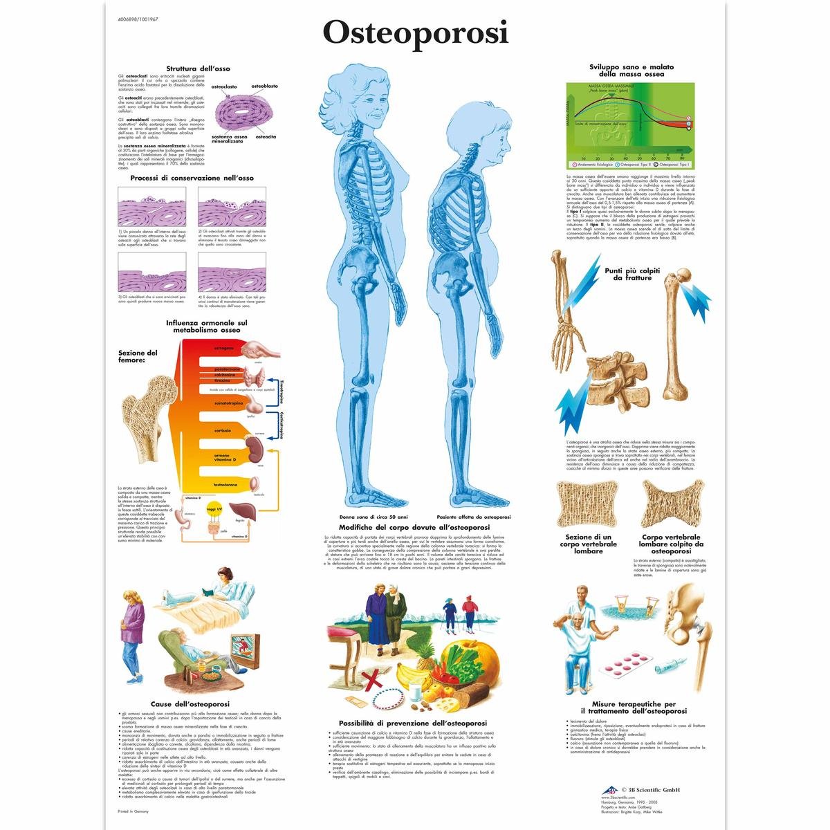 3B Scientific VR4121L Osteoporosis