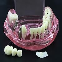 Vista 7 de Modelo de dientes dentales modelo de implante Typodont enseña estudio demostración análisis de dientes, demostración de restauración de dientes 2001