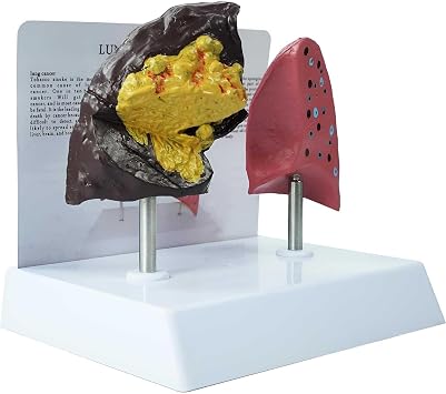 Smokers Lung vs Healthy Lung Comparative Model - Life Size Anatomical Display for Medical Education, Respiratory Health Study Tool with Pathological Features, PVC Structure