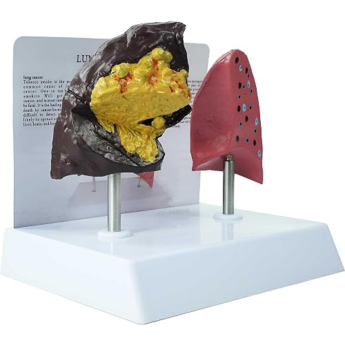 Smoker's Lung vs Healthy Lung Comparative Model - Life Size