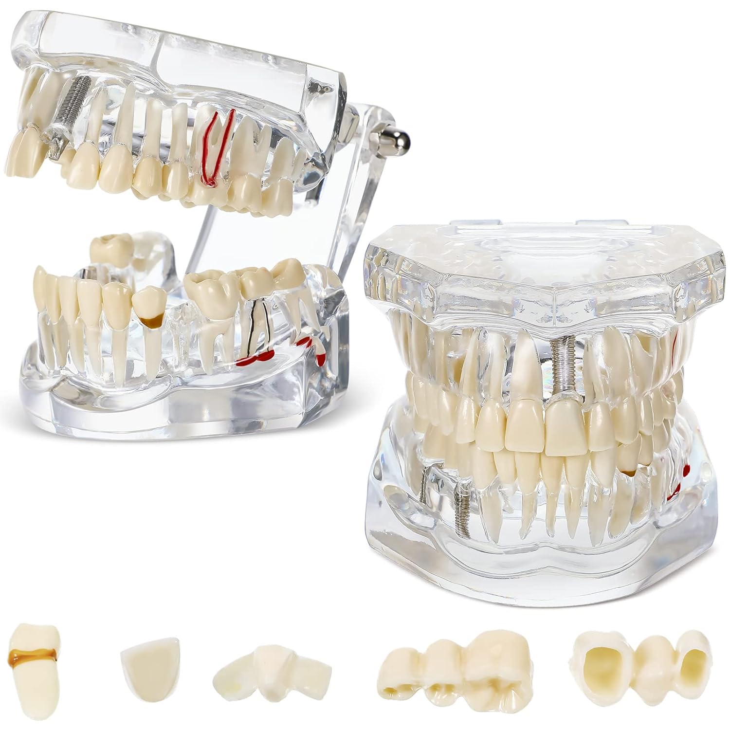 Outus Disease Teeth Model Dental Implant Teeth Model with Removable Tooth Dentist Standard Tooth Pathological Demonstration for Christmas Education Dental Supplies(Transparent,2 Pcs)