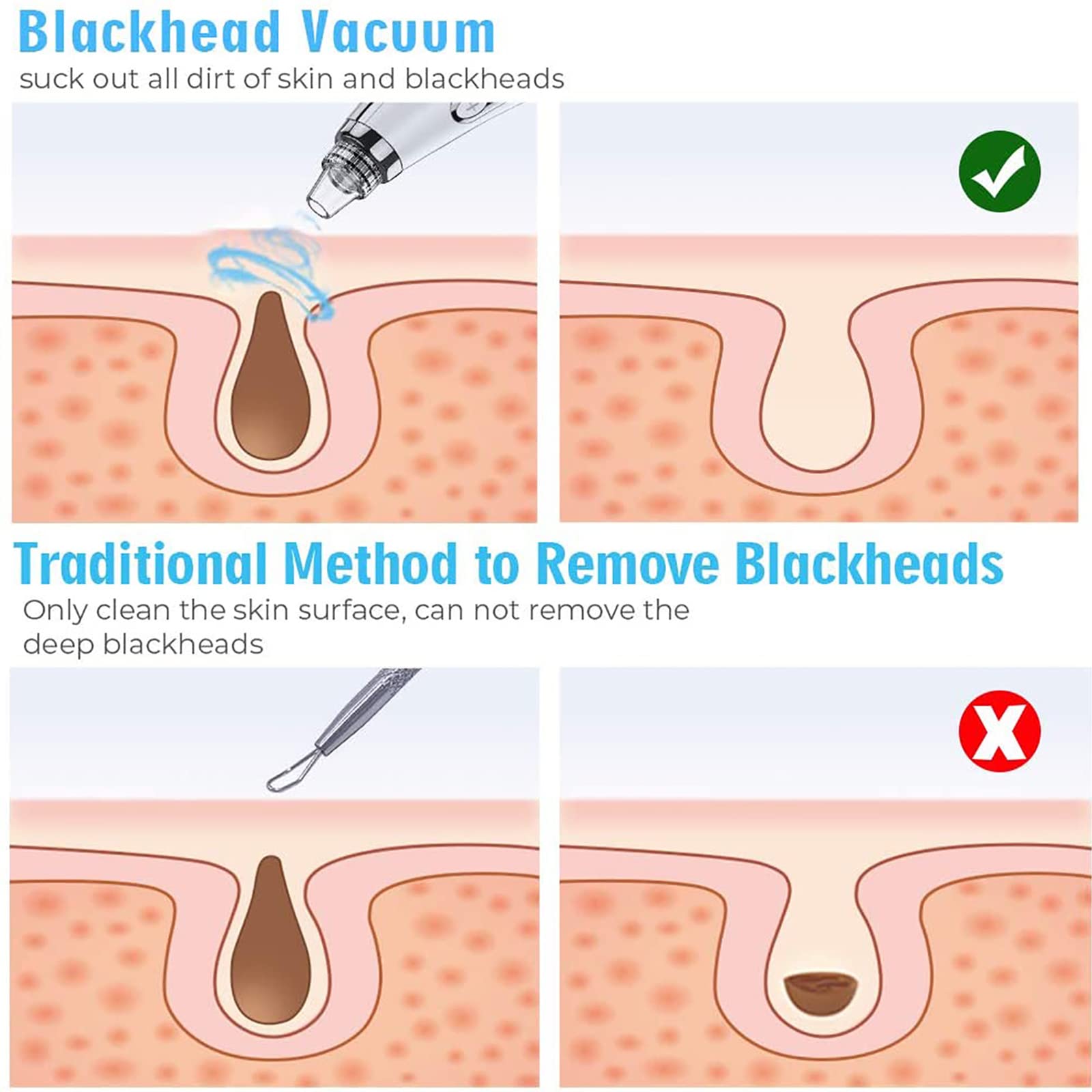 Aspirador de poros para eliminar puntos negros, limpiador de poros faciales, herramienta extractora de puntos blancos de comedones de acné, limpiador eléctrico de poros de aspiradora facial,