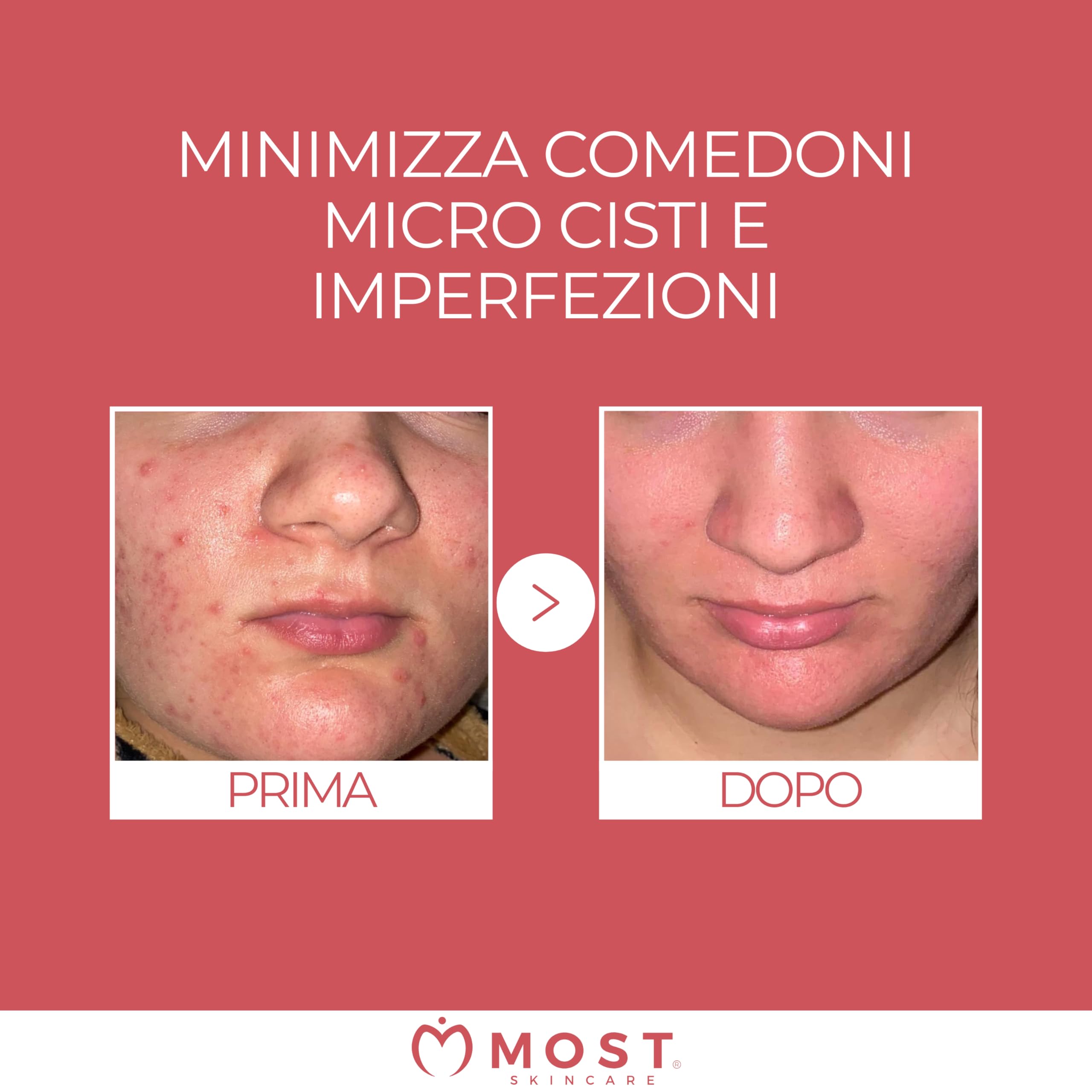 MOST - Glicosal Esfoliante Viso Micropeeling, Lozione con Acido Salicilico e Acido Glicolico - Delicata Azione Peeling Viso e Anti Macchie, Pelle a Tendenza Acneica, Impura, Melasma, Imperfezioni 50ml