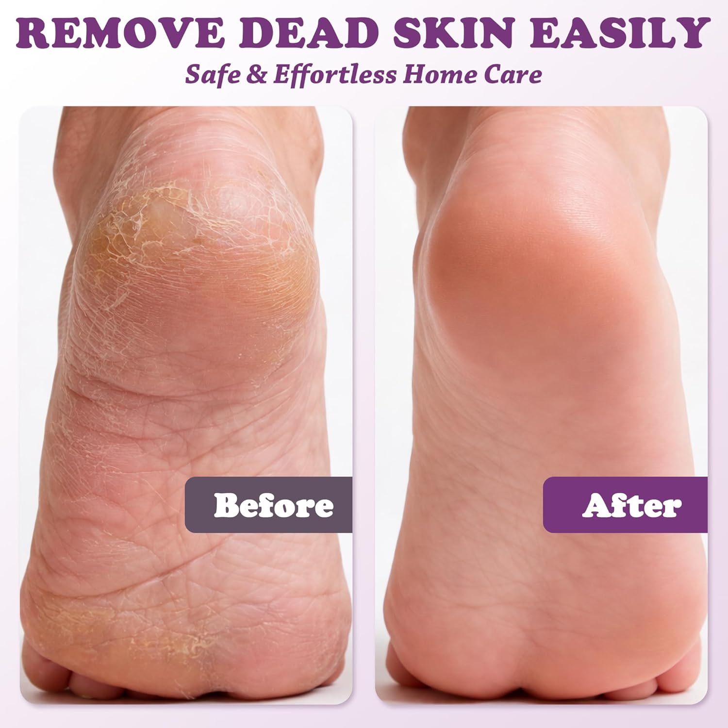 Electric Foot Callus Remover – 50pcs Replacement Sandpaper Discs, 2000mAh Battery, 3 Replacement Heads & 5 Speeds, Cordless Rechargeable Pedicure Tool for Cracked Heels & Dead Skin Care (Purple)