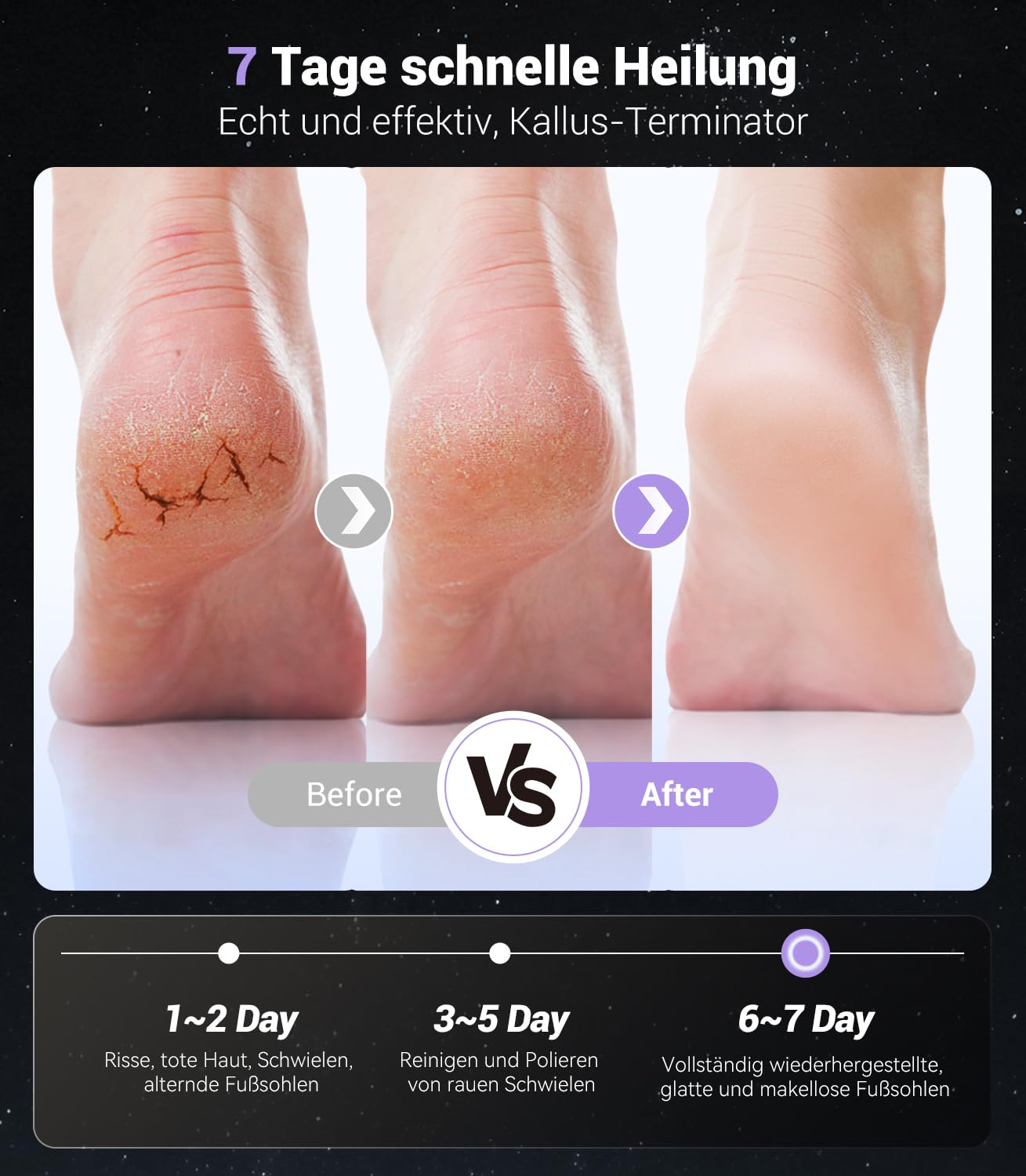 9.0 Upgrade 5-IN-1 - Eliminador de callos eléctrico (elimina el 99,92% de callos en 3 minutos) con tecnología de sensor para pieles muertas y duras (morado)