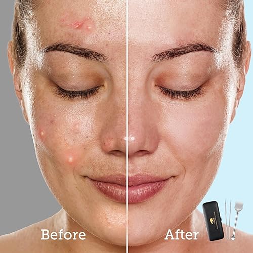 Miniatura 6 de LitBear Herramienta de preparación de poros, kit de herramientas para eliminar puntos negros, herramienta de extracción de espinillas de acero