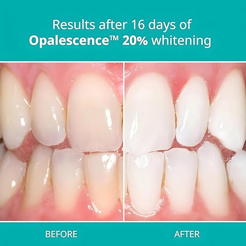 Miniatura 3 de Opalescence PF 20% Melón blanqueamiento dental 12 unidades