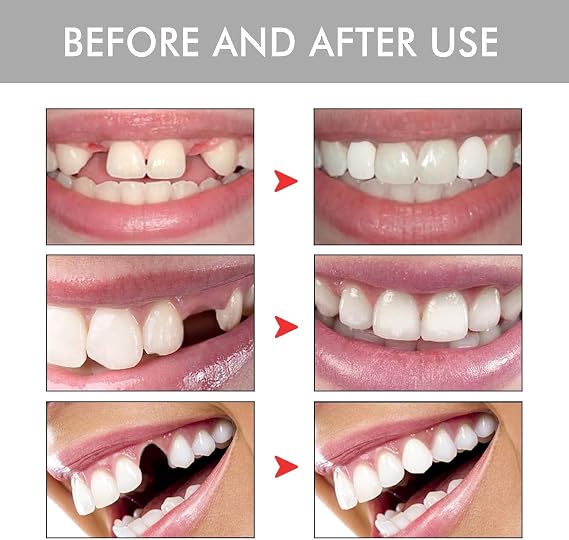 Silicone Denture Set, False Teeth & Fake Braces Kit, Soft Reline for Upper & Lower Dentures, Temporary Tooth Replacement & Snap on Veneers for Men & Women, Comfortable & Moldable Silicone Teeth Covers