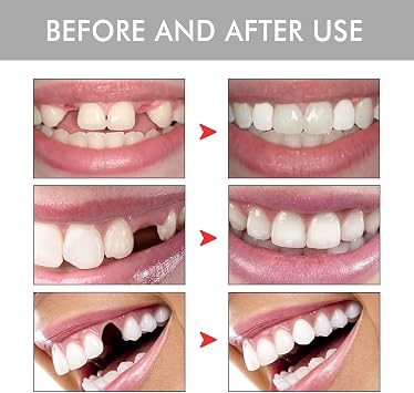 Silicone Denture Set, False Teeth & Fake Braces Kit, Soft Reline for Upper & Lower Dentures, Temporary Tooth Replacement & Snap on Veneers for Men & Women, Comfortable & Moldable Silicone Teeth Covers