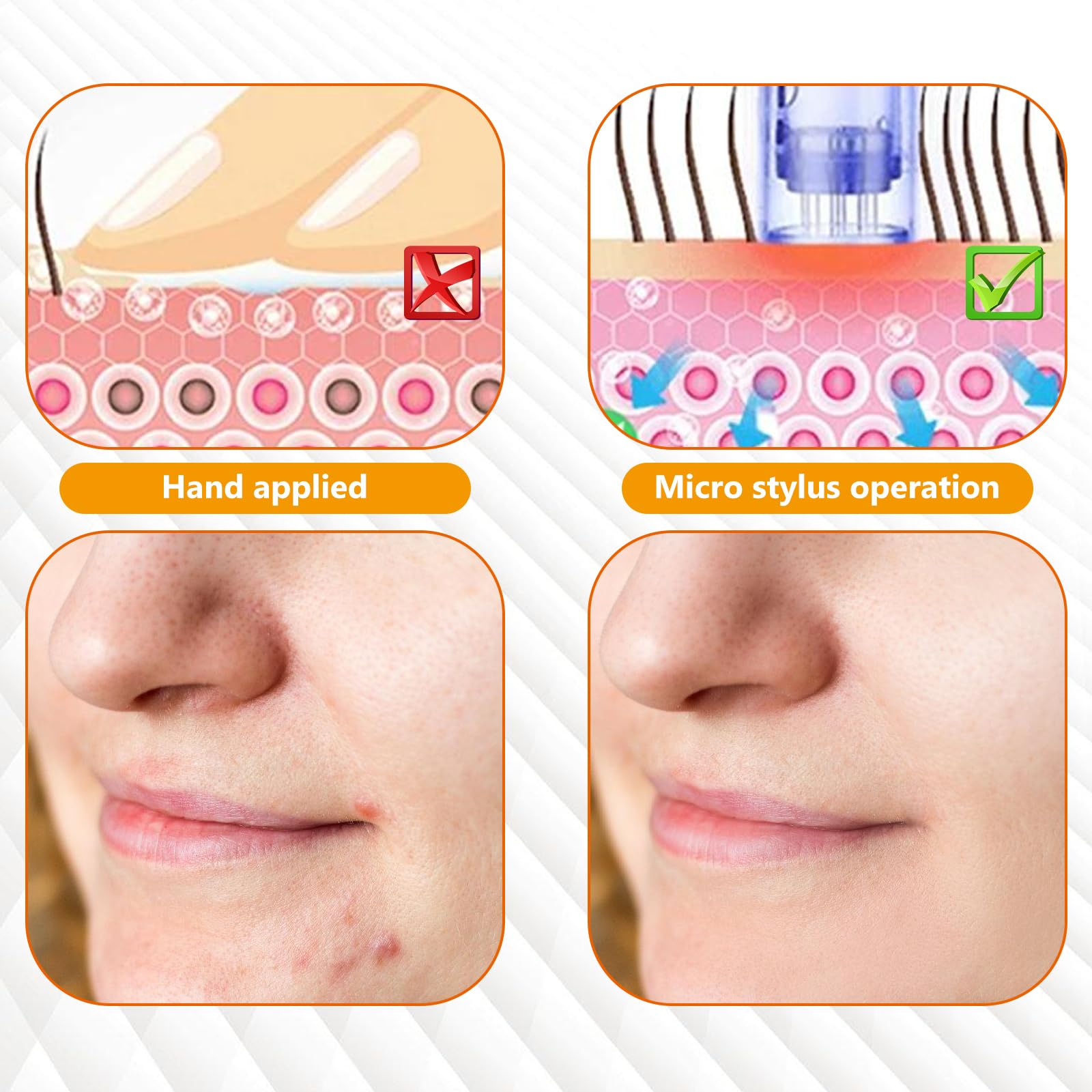 30 Piezas Agujas Dermapen Microneedling,36 Pin Micro Aguja Microagulhas Agulhas De Repuesto para Microneedling Derma Pen Regular Microneedle para Antienvejecimiento Rejuvenecimiento Arrugas(Bayoneta)