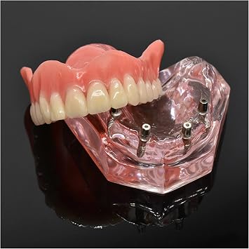 Dental Typodont Implant Teeth Model Pink Clear Overdenture 4 Implants Maxillary Superior Upper Restoration Demo M6001 for Studying Teaching
