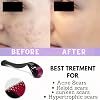 Derma Roller 540 Titanium Needles For Acne Scars, Face Facial Wrinkles Hair Loss Stretch Marks Hair Operation Scars Regrowth Micro Needles Professional Micro needling Derma Needling (1mm)