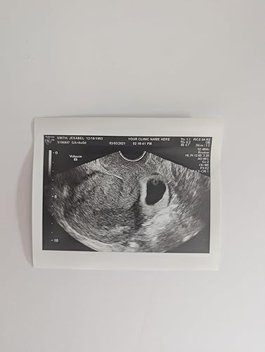 Miniatura 4 de Prank 2D Customized Fake Ultrasound Single Photo ONLY NO Gender