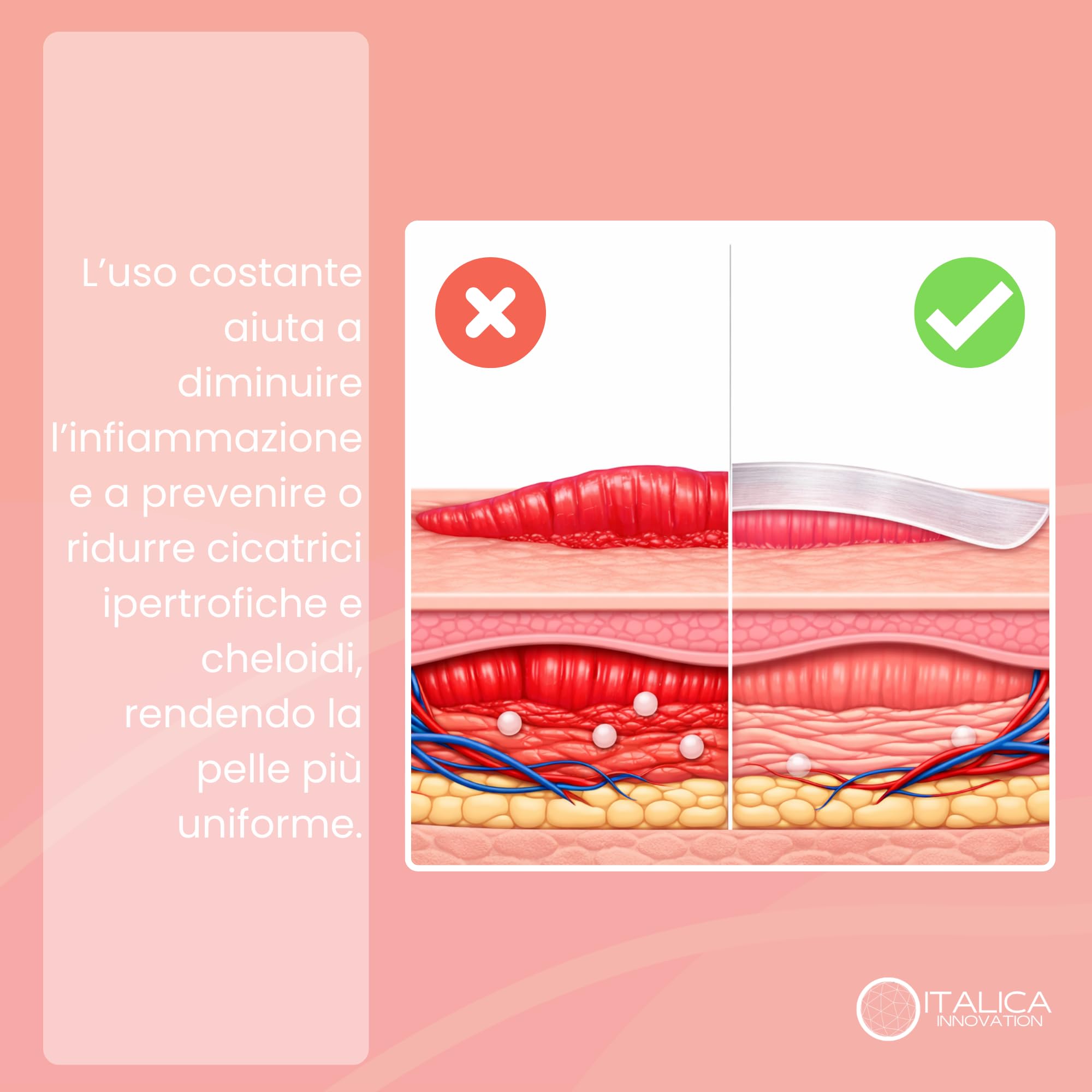Cerotti in Silicone per Cicatrici, 4x300cm, Ipoallergenici e Riutilizzabili, Impermeabili Post Operatorio, per Cicatrici Chirurgiche, Cesareo, Acne e Cheloidi