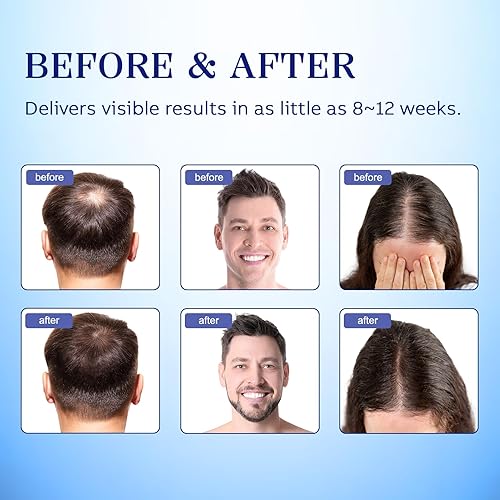 Miniatura 4 de 5% de minoxidil para cabello de hombres, minoxidil para mujeres para el crecimiento del cabello, spray de minoxidil para hombres y mujeres,