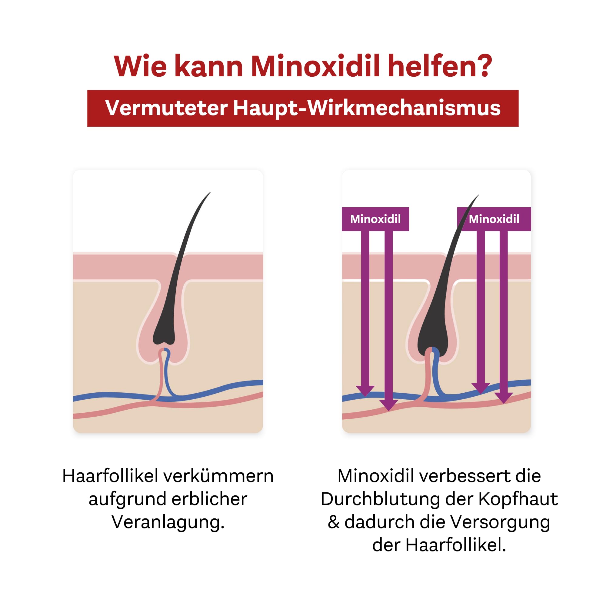 Minoxidil DoppelherzPharma 20mg/ml (2%) Lösung zur Anwendung auf der Haut (Kopfhaut) – Arzneimittel zur Behandlung von anlagebedingtem Haarausfall bei Frauen (2x3x 60ml)