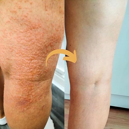 Miniatura 5 de Suplemento de psoriaskin Strength & Spices, refuerzo del sistema inmunológico con 31 ingredientes potentes y aminoácidos, alivia la piel roja,