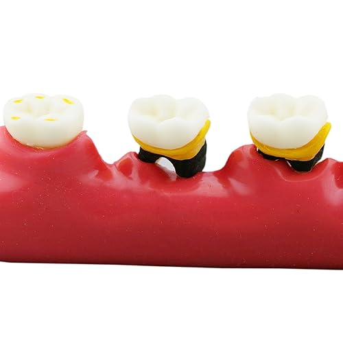 Miniatura 5 de Dental Typodont Dientes Modelo M4010 Demuestra El Progreso De La Enfermedad Periodontal Categoría Patología Disección Enseñanza Estudio Demo