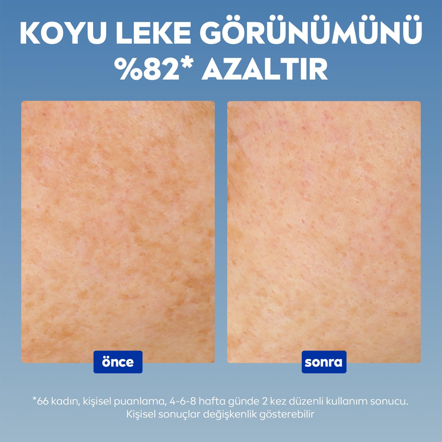 NIVEA Luminous630 Thiamidol Etkili Leke Karşıtı Cilt Serumu 30ml, Hyaluronik Asit, Cilt Tonu Eşitleyici,Aydınlık Görünüm
