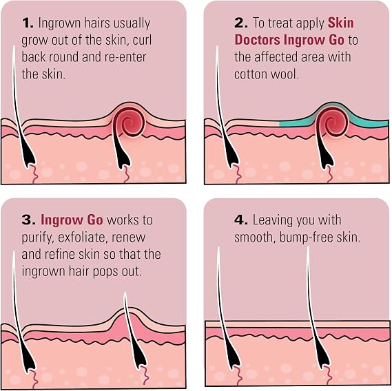Skin Doctors Ingrow Go Lotion | Ingrown Hair Treatment | Reduces Razor Burns & Bumps I Use on Legs, Bikini Line, Underarm & face | 120ml (Pack of 3)