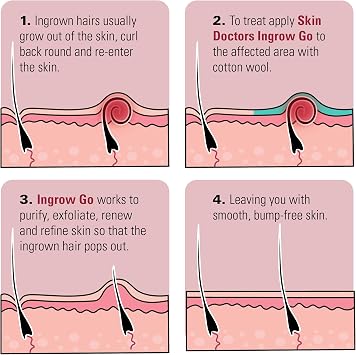 Skin Doctors Ingrow Go Lotion | Ingrown Hair Treatment | Reduces Razor Burns & Bumps I Use on Legs, Bikini Line, Underarm & face | 120ml (Pack of 3)