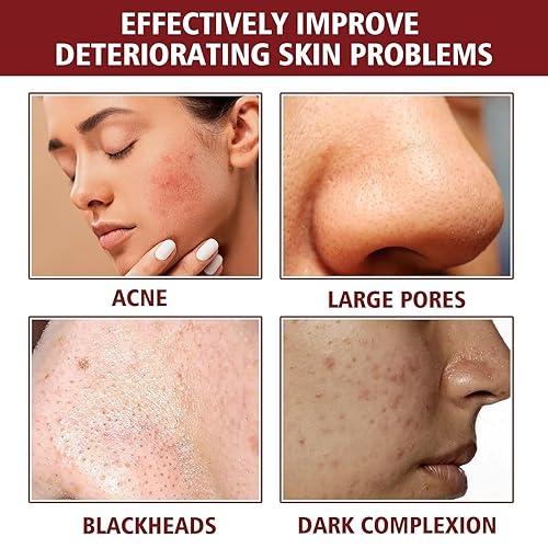 Miniatura 8 de AHA 30% + BHA 2% Solución de pelado, ácido glicólico con ácido láctico, AHA BHA Exfoliante para poros grandes, arrugas y líneas finas, exfoliante