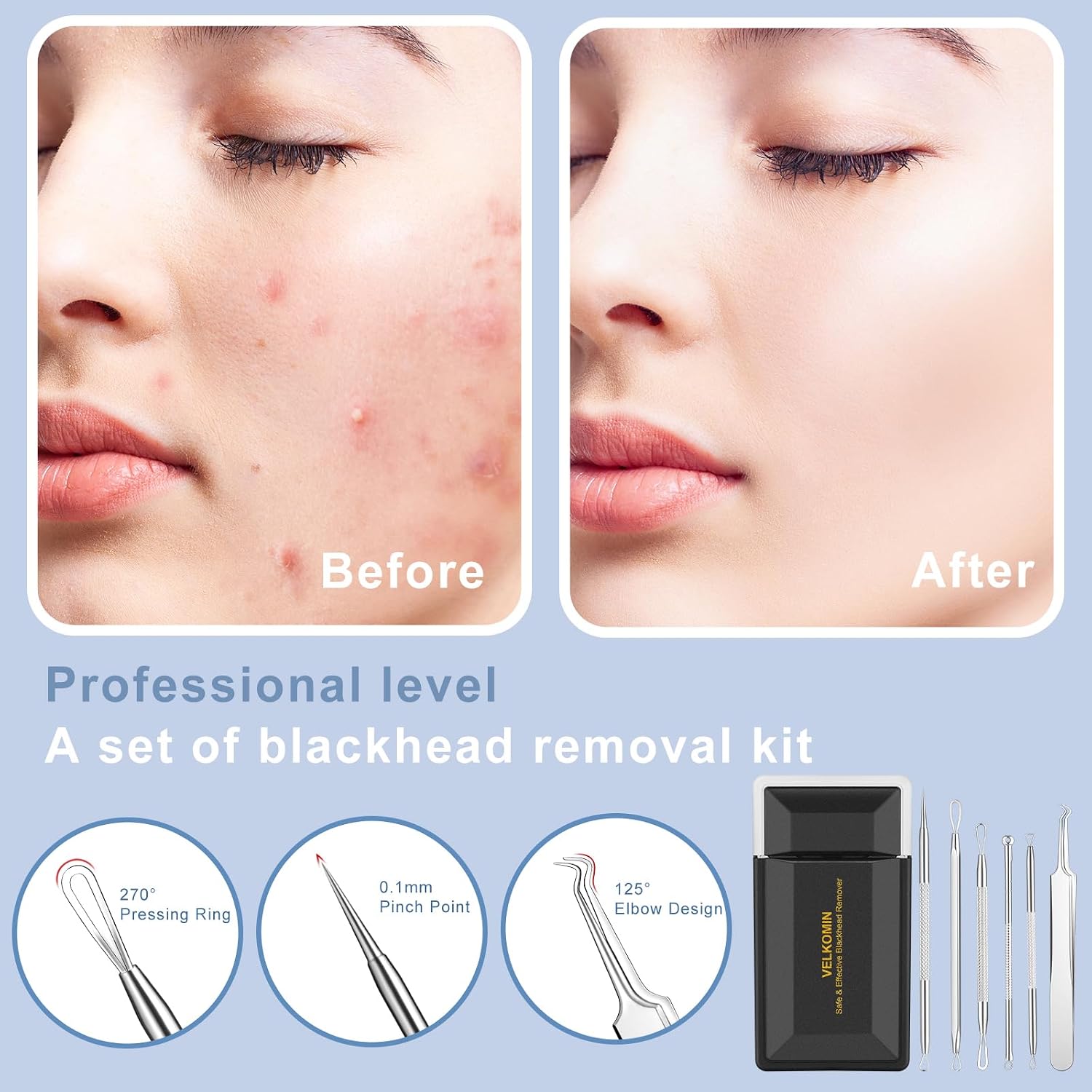 Pimple Extractor Tools, 6-PCS Professional Stainless Steel Blackheads, Whiteheads, Pimples, Boils, Stray Hairs Remover Tools Set with Mirror and Product User Manual, 18-Month Replacement Warranty！