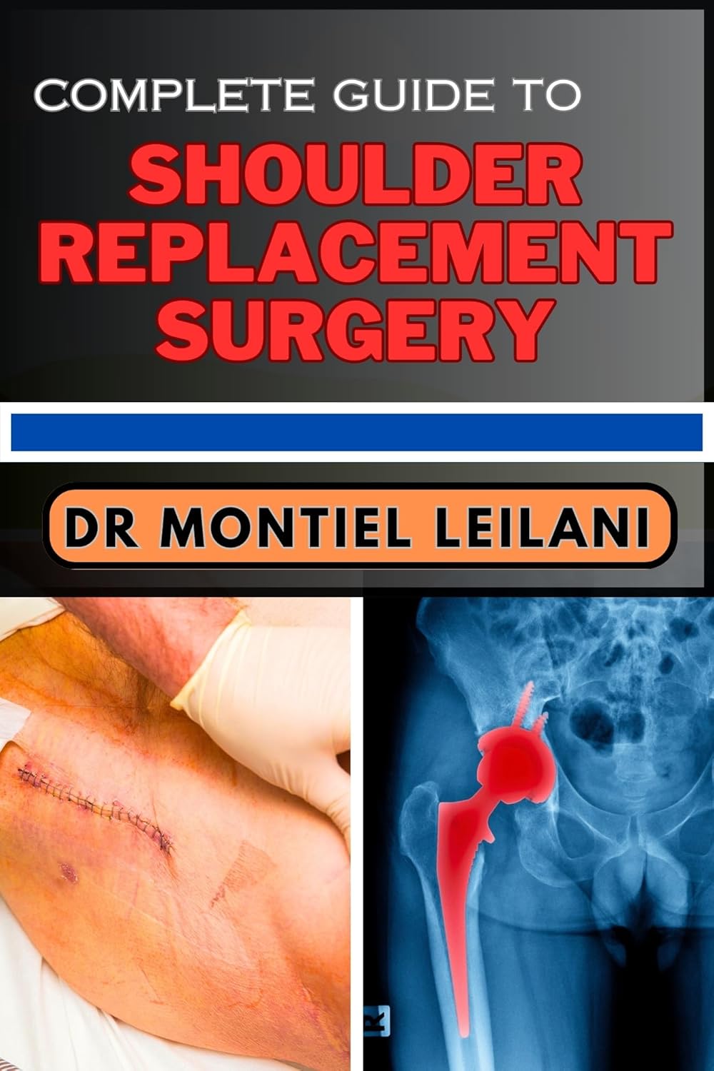 COMPLETE GUIDE TO SHOULDER REPLACEMENT SURGERY