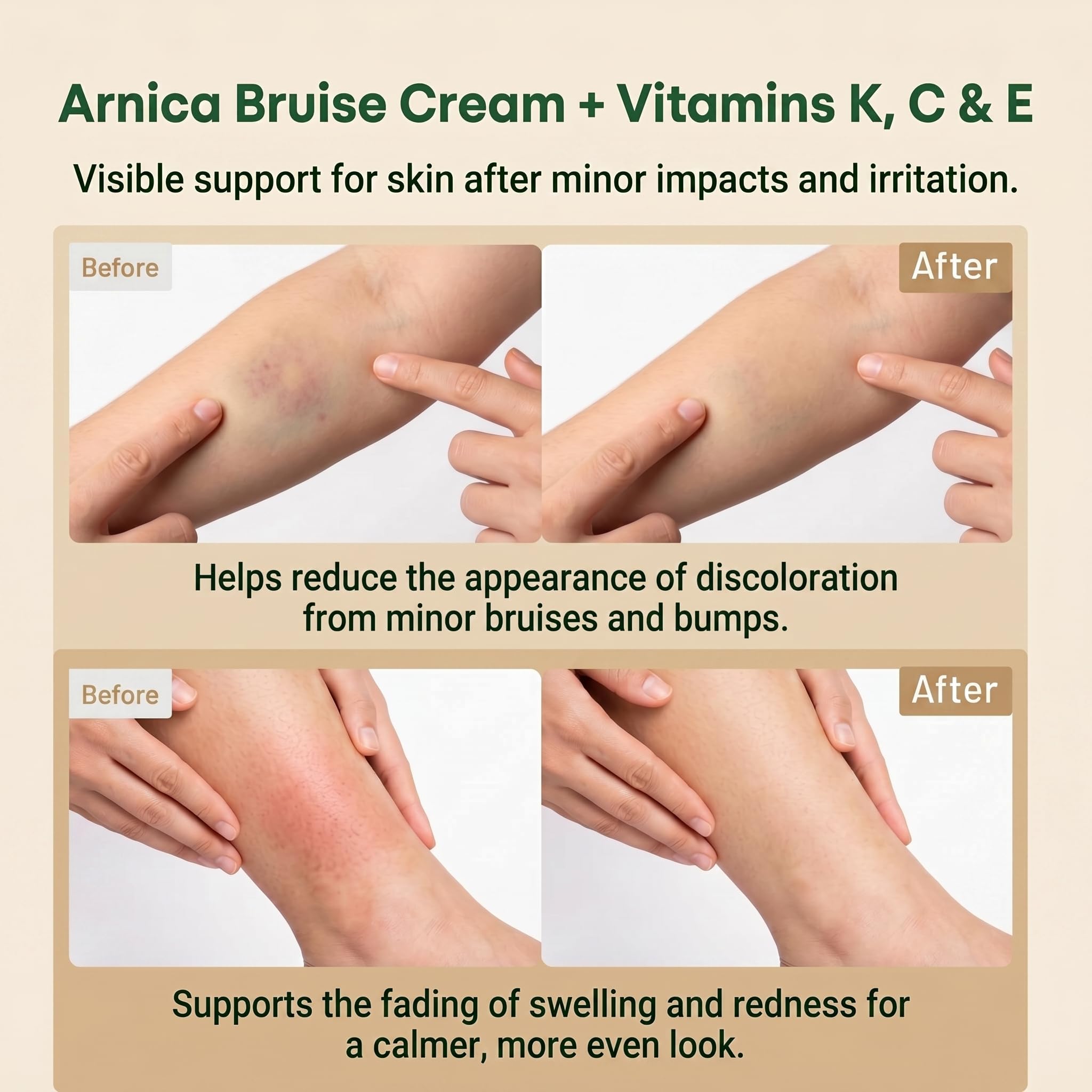 Extra Strength Arnica Bruise Cream with Vitamins K, C & E