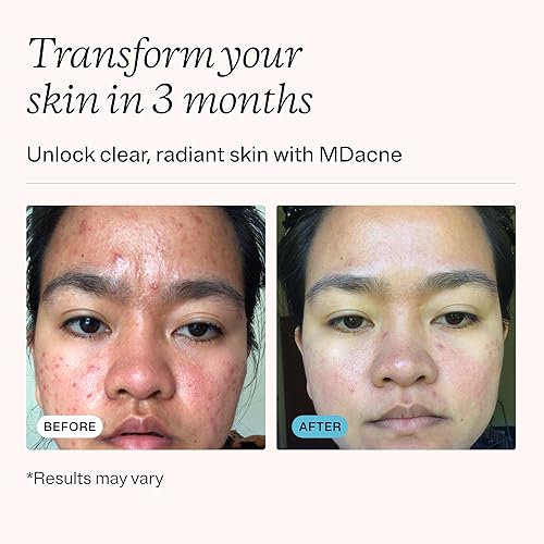 Miniatura 3 de MDacne Kit de Tratamiento Facial para Acné en 3 Pasos, Crema de Peróxido de Benzoilo 2.5%, Limpiador de Ácido Salicílico, Hidratante de Niacinamida