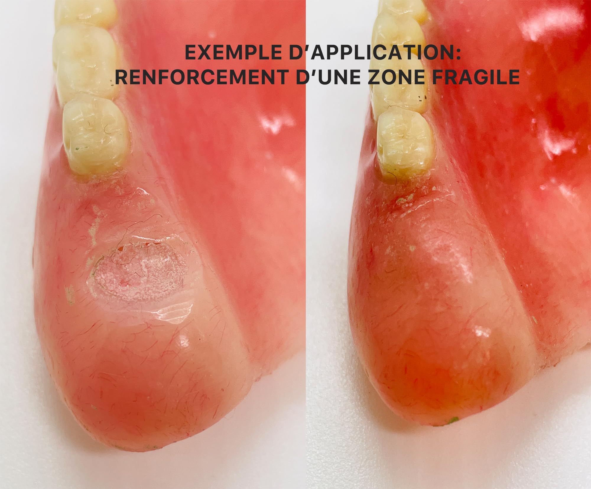 RESINE DENTAIRE ROSE | MEDIDENT |- réparations des prothèse dentaires-dentier cassé-dent détachée