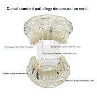 Vista 2 de Modelos de Implantes Dentales Restauración Typodont Dientes Modelo Demostración Oral Patología Puente Enseñar Estudio Color Claro M2001