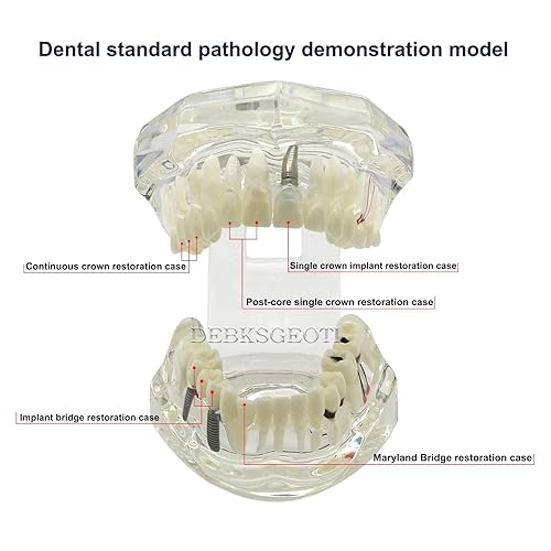 Miniatura 2 de Modelos de Implantes Dentales Restauración Typodont Dientes Modelo Demostración Oral Patología Puente Enseñar Estudio Color Claro M2001