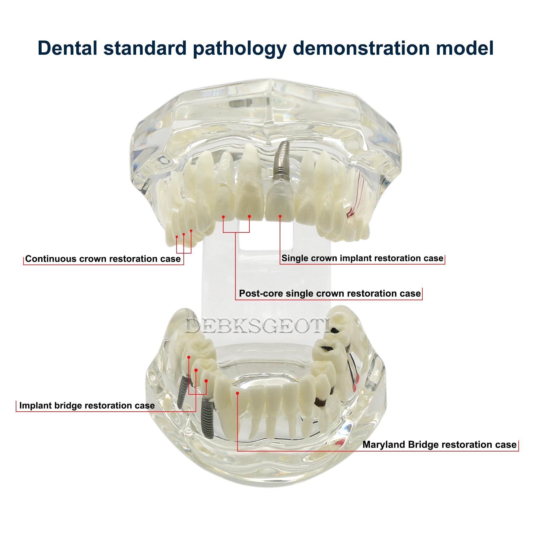 Modelo De Ortodoncia Dental Tipodonte/modelo De Restauración Dental De Modelo De Restauración De Prótesis 303948498626