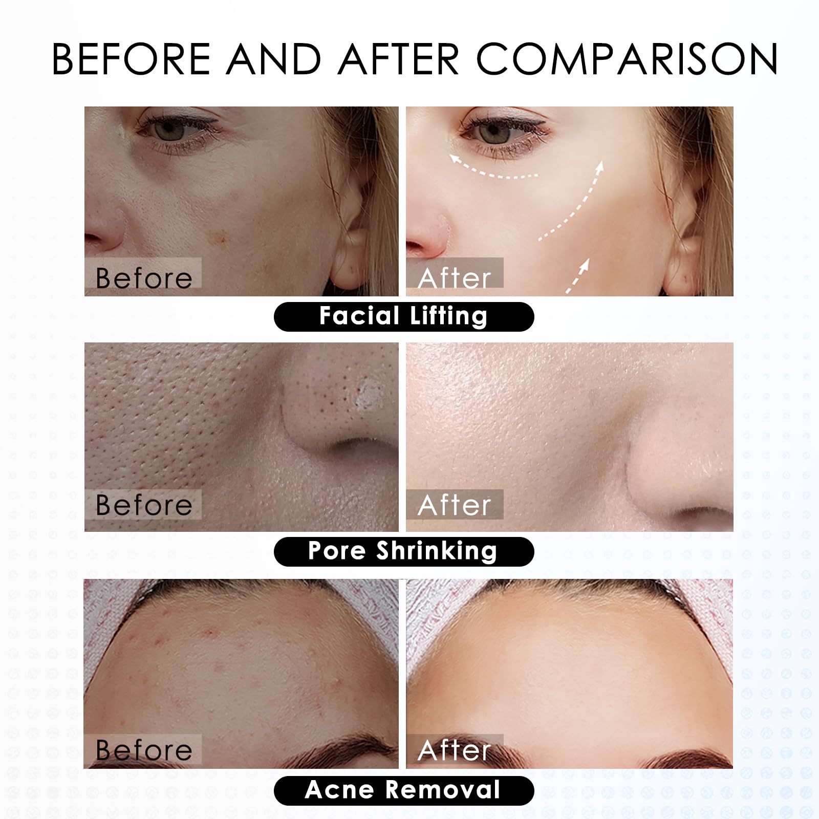 Plasma Pen Professional für Aknebehandlung – Professionelles Hautpflegegerät zur Entfernung von Aknenarben, Porenverfeinerung & Gesichtslifting, Tragbares Beauty-Gerät mit USB-Ladefunktion