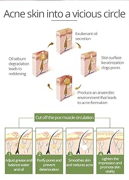 AICHUN BEAUTY Anti-Acne Facial Serum Aloe Vera Extract Salicylic Acid Repairs Damaged Skin 30ml