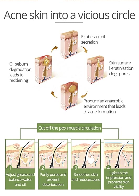 AICHUN BEAUTY Anti-Acne Facial Serum Aloe Vera Extract Salicylic Acid Repairs Damaged Skin 30ml