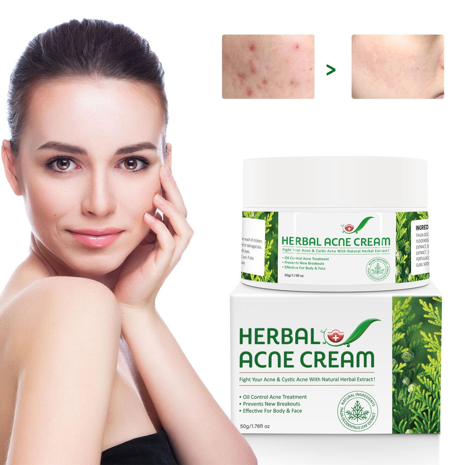 Herbal Acne Cream丨Spot Cream For Acne & Spot & Pimple丨Spot and Acne Gel For Face and Body Reduces Spots and Redness with Aloe Vera for All Skin Types