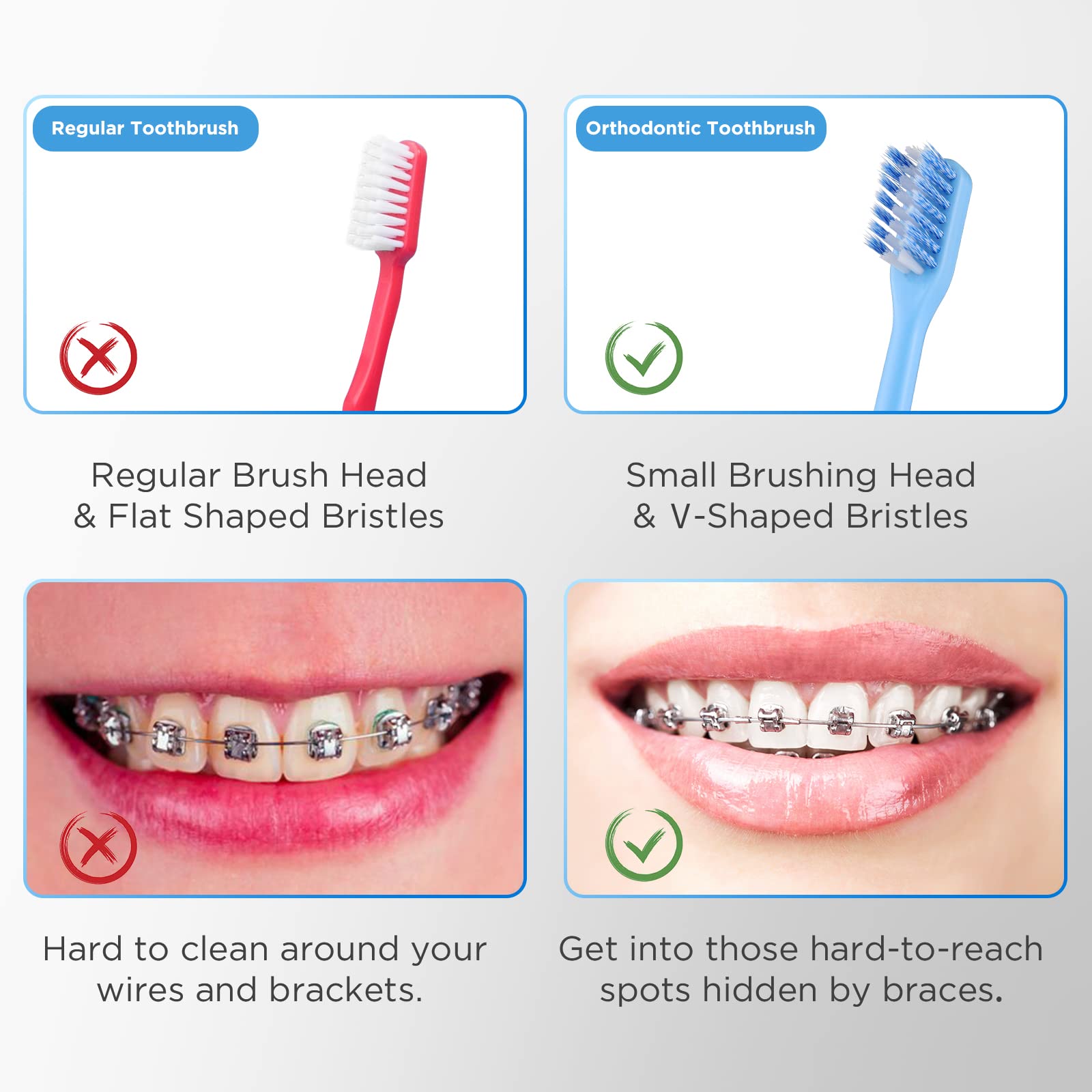 Fremouth Cepillo de dientes ortodóntico en forma de V para aparatos ortopédicos, cerdas suaves, 6 unidades