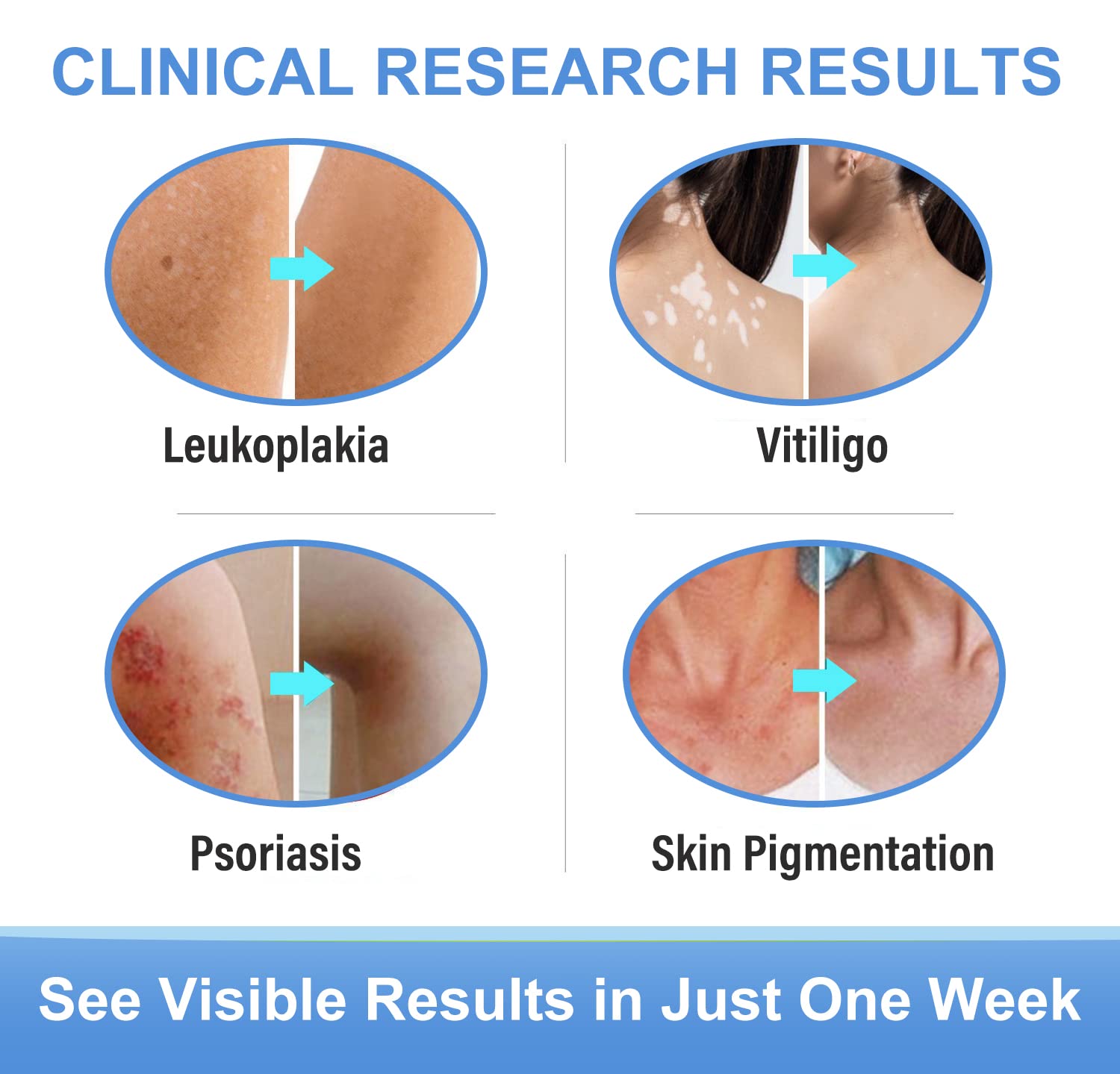 Vitiligo Cream, Natural Vitiligo Treatment for Skin Vitiligo, Easy to Use, Vitiligo Care Cream, Reduce White Spots and Improve Skin Pigmentation, 20g