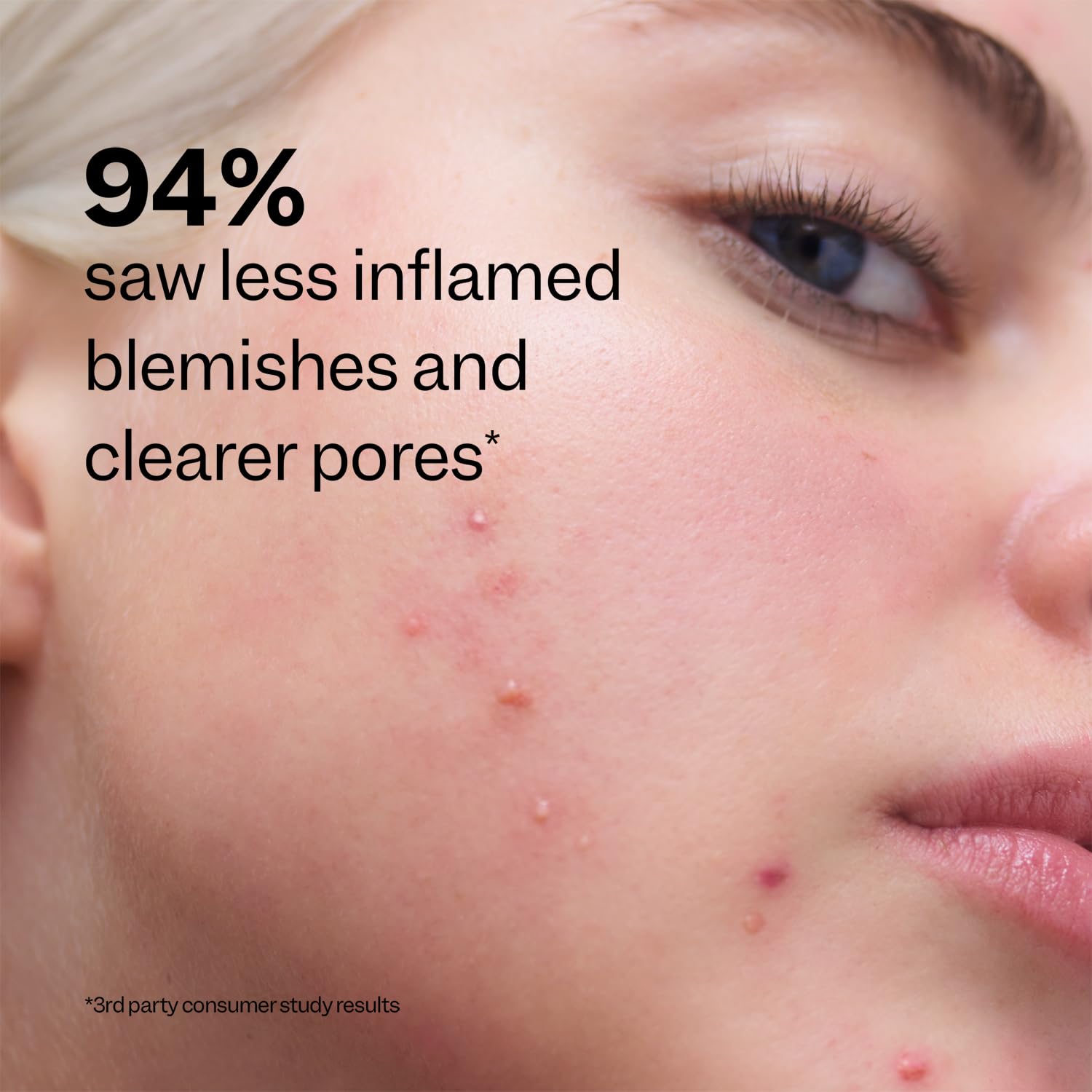 Peach Slices - Acne Clarifying Cleanser (4.05 oz) - 2% Salicylic Acid Acne Treatment - Clear & Prevent Breakouts, Hydrate - Cucumber, Cica, Acerola - Vegan, Cruelty Free, Korean Skin Care & Beauty - Image 6