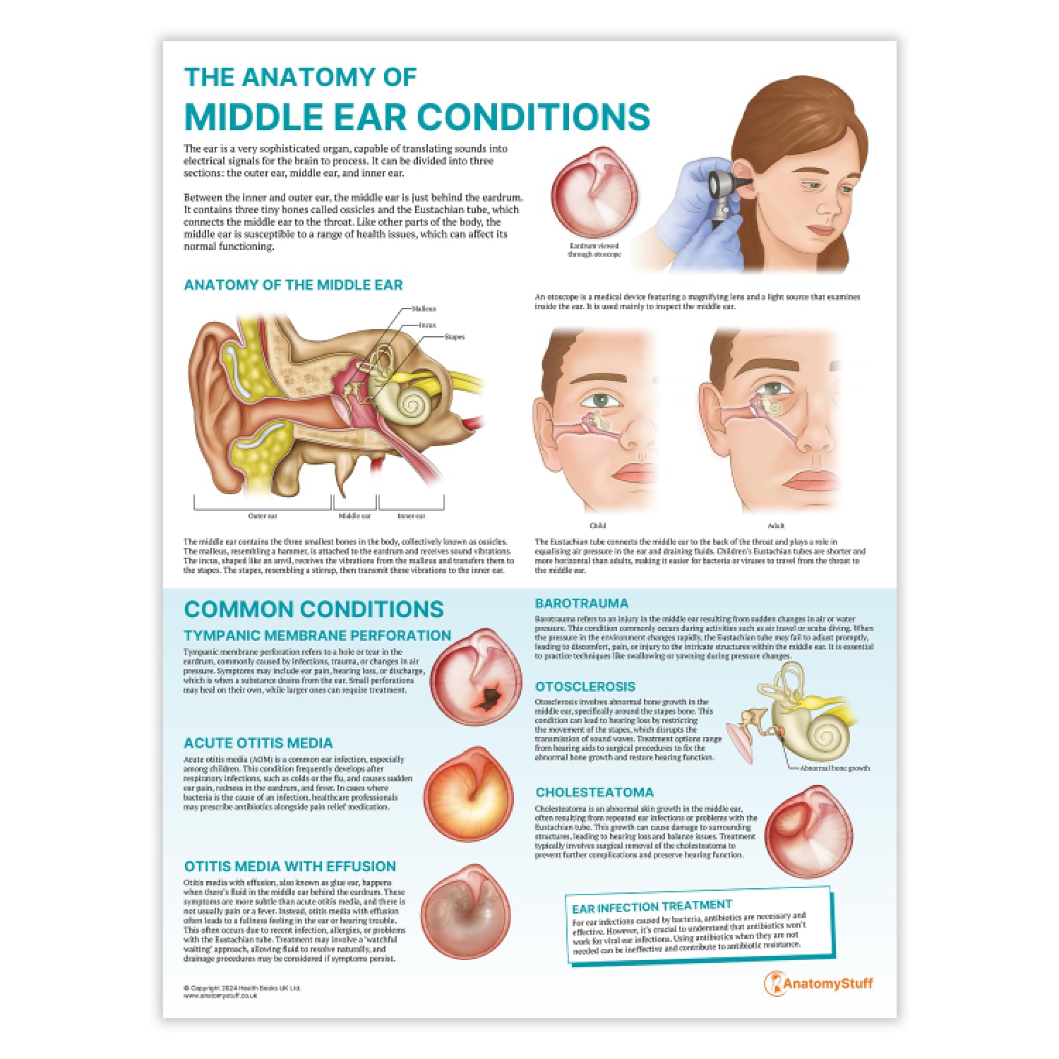Anatomy Stuff Middle Ear Conditions The Anatomy Of Poster/Chart, 45X60cm, 18X24 Inches, Ent Learning Tool, Ear Anatomical Wall Diagram