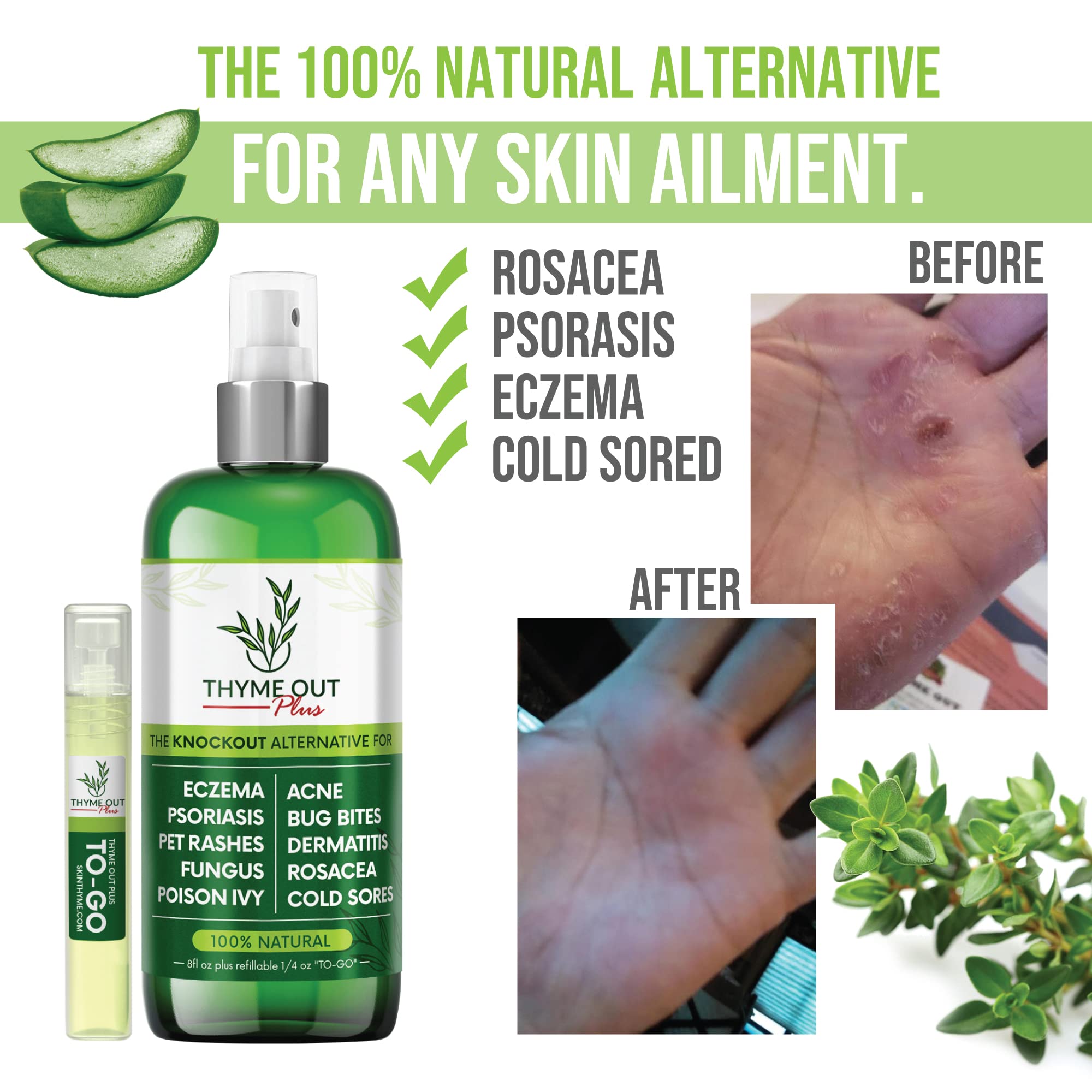 Buy Thyme Out Plus Eczema Treatment, Psoriasis Treatment Treats Acne