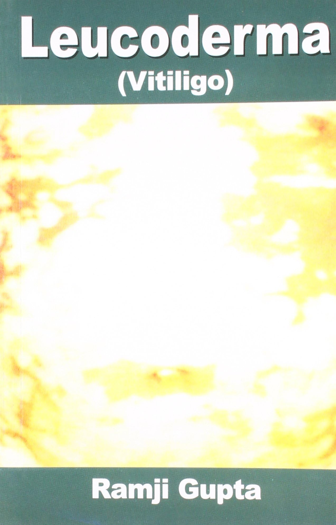 Leucoderma English(PB) Paperback – 1 January 2012