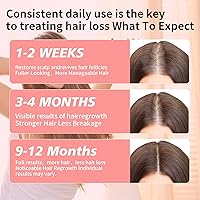 Vista 3 de 5% de minoxidil para hombres y mujeres, espuma de minoxidil para el crecimiento del cabello de las mujeres, tratamiento tópico de pérdida