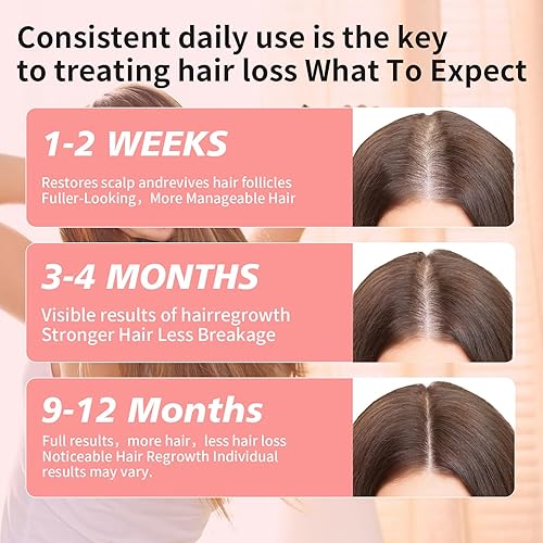 Miniatura 3 de 5% de minoxidil para hombres y mujeres, espuma de minoxidil para el crecimiento del cabello de las mujeres, tratamiento tópico de pérdida de